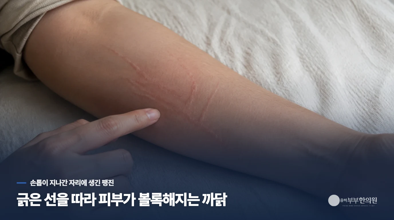 긁은 선을 따라 피부가 볼록해지는 까닭