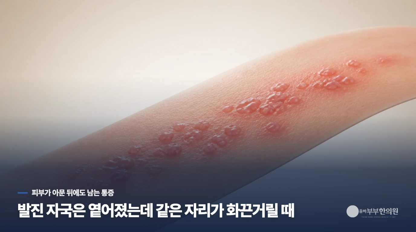 발진 자국은 옅어졌는데 같은 자리가 화끈거릴 때